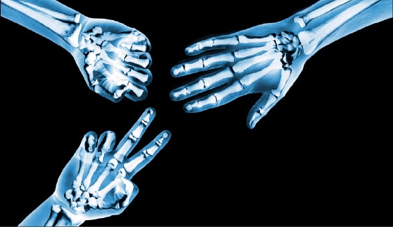 x-ray of the arms